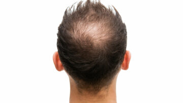 Haarausfall stoppen